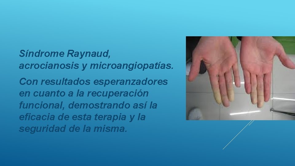 Síndrome Raynaud, acrocianosis y microangiopatías. Con resultados esperanzadores en cuanto a la recuperación funcional,