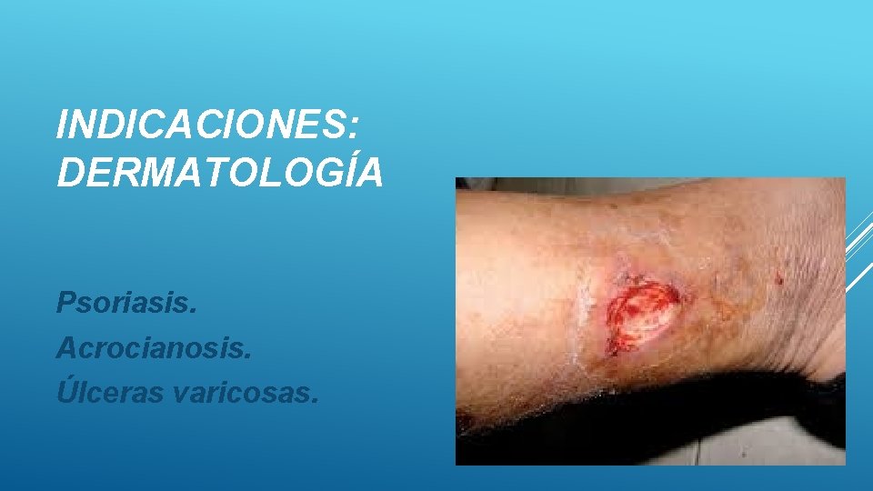 INDICACIONES: DERMATOLOGÍA Psoriasis. Acrocianosis. Úlceras varicosas. 