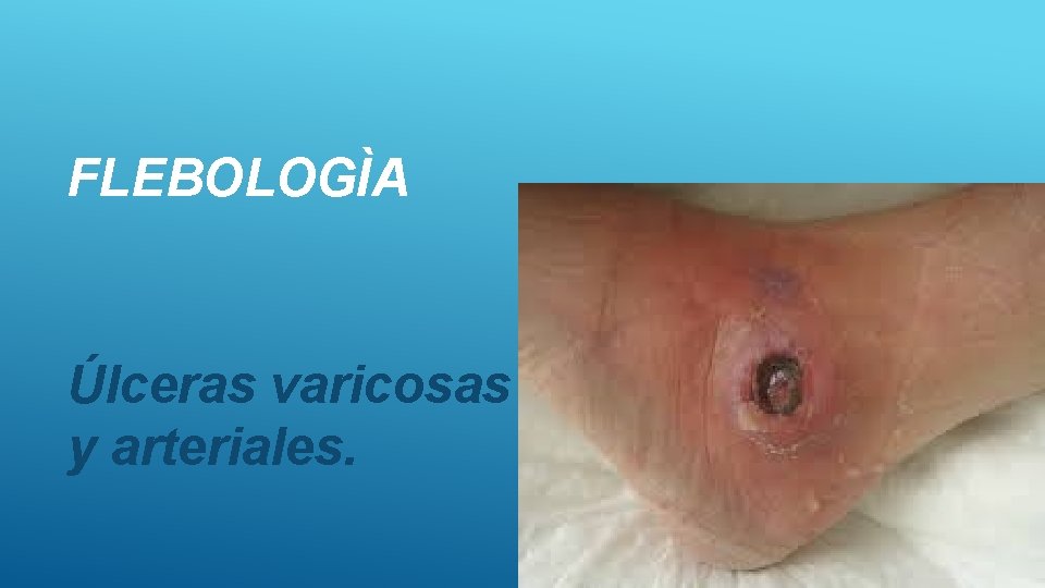 FLEBOLOGÌA Úlceras varicosas y arteriales. 