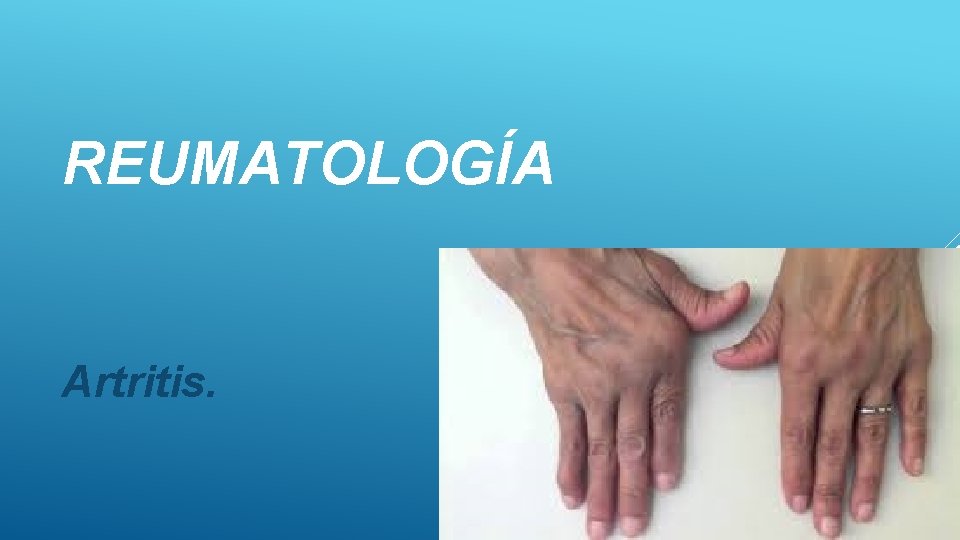 REUMATOLOGÍA Artritis. 