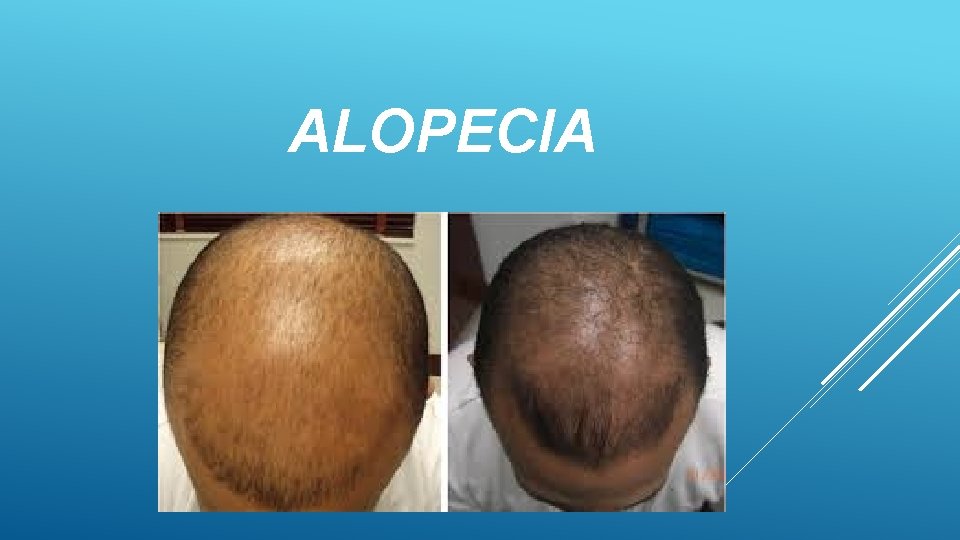 ALOPECIA 