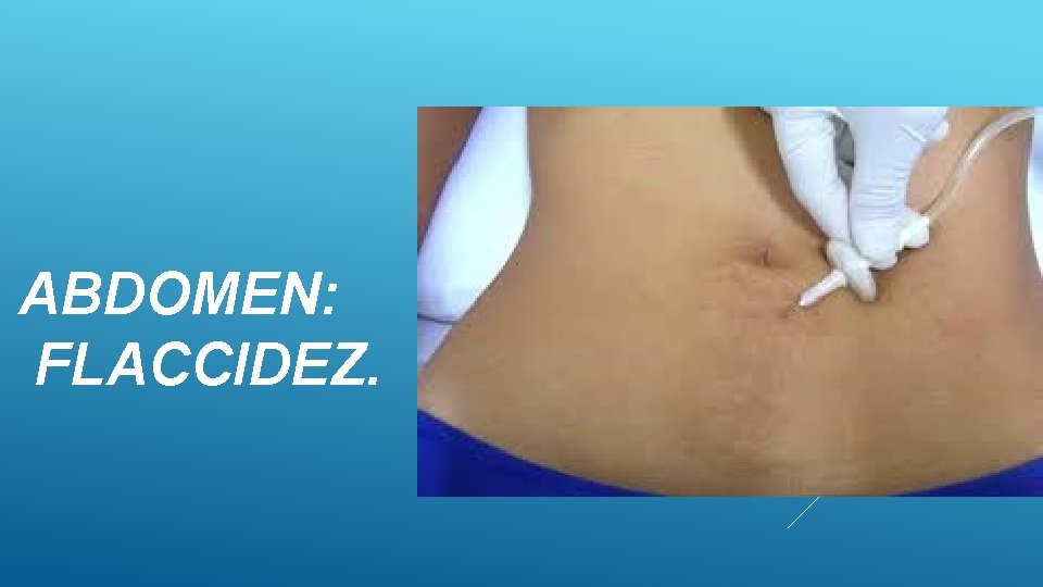 ABDOMEN: FLACCIDEZ. 