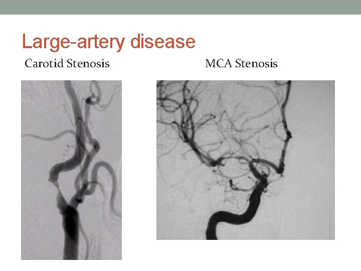 Large-artery disease Carotid Stenosis MCA Stenosis 