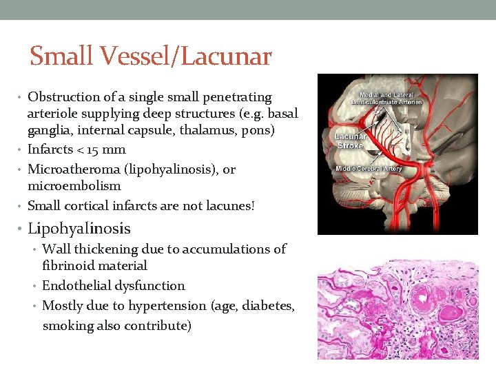 Small Vessel/Lacunar • Obstruction of a single small penetrating arteriole supplying deep structures (e.