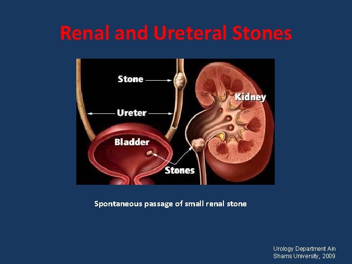 Renal and Ureteral Stones Spontaneous passage of small renal stone Urology Department Ain Shams