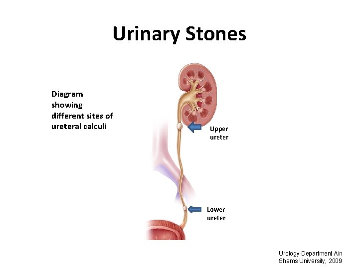 Urinary Stones Diagram showing different sites of ureteral calculi Upper ureter Lower ureter Urology