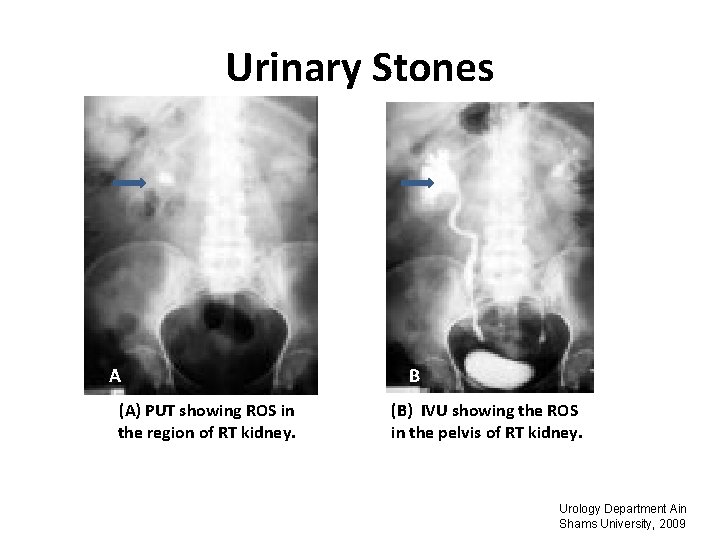 Urinary Stones A (A) PUT showing ROS in the region of RT kidney. B