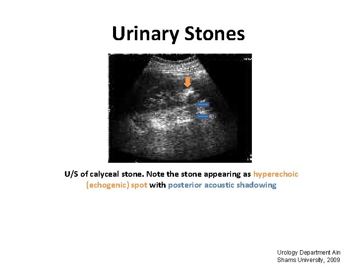 Urinary Stones U/S of calyceal stone. Note the stone appearing as hyperechoic (echogenic) spot