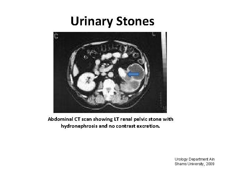 Urinary Stones Abdominal CT scan showing LT renal pelvic stone with hydronephrosis and no