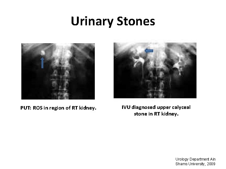 Urinary Stones PUT: ROS in region of RT kidney. IVU diagnosed upper calyceal stone