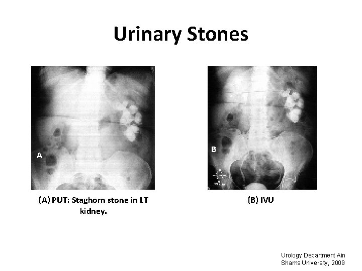 Urinary Stones A (A) PUT: Staghorn stone in LT kidney. B (B) IVU Urology