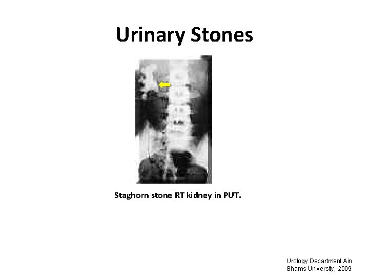 Urinary Stones Staghorn stone RT kidney in PUT. Urology Department Ain Shams University, 2009