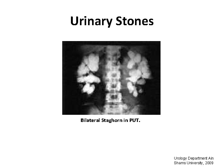 Urinary Stones Bilateral Staghorn in PUT. Urology Department Ain Shams University, 2009 