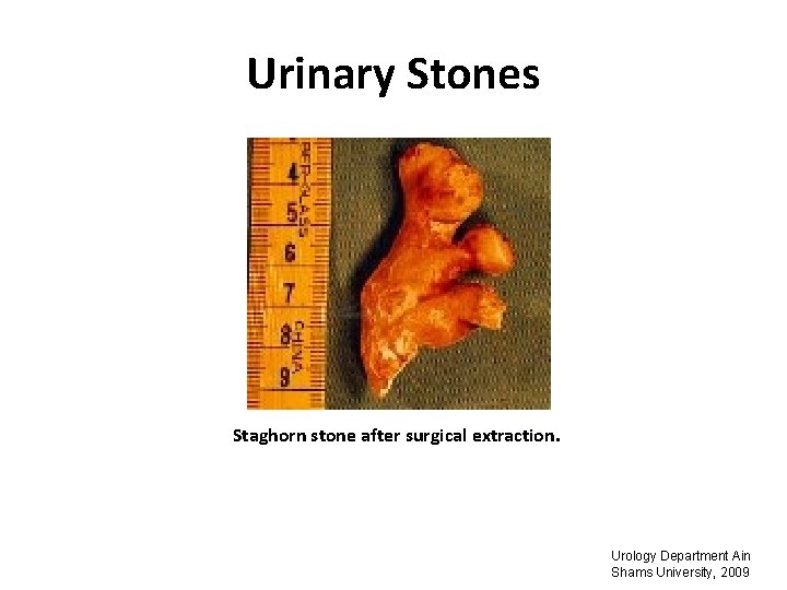 Urinary Stones Staghorn stone after surgical extraction. Urology Department Ain Shams University, 2009 