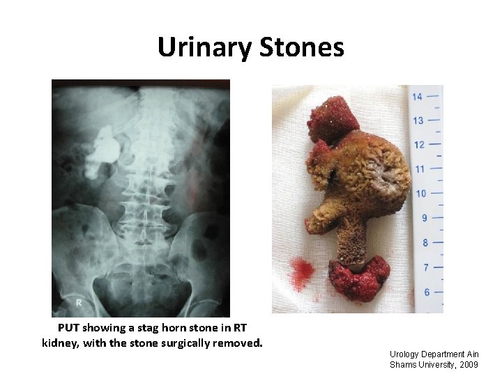 Urinary Stones PUT showing a stag horn stone in RT kidney, with the stone