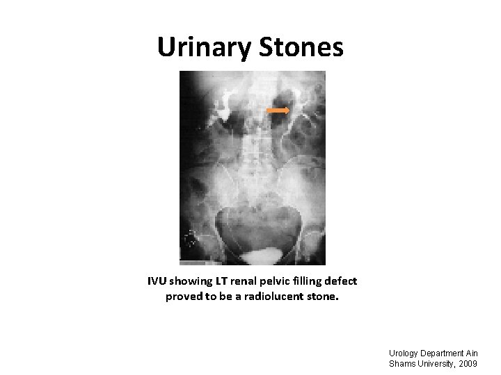 Urinary Stones IVU showing LT renal pelvic filling defect proved to be a radiolucent