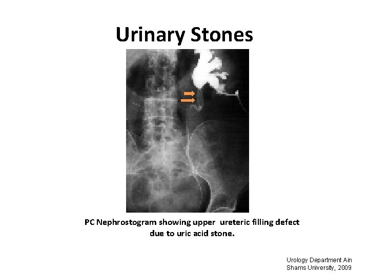 Urinary Stones PC Nephrostogram showing upper ureteric filling defect due to uric acid stone.