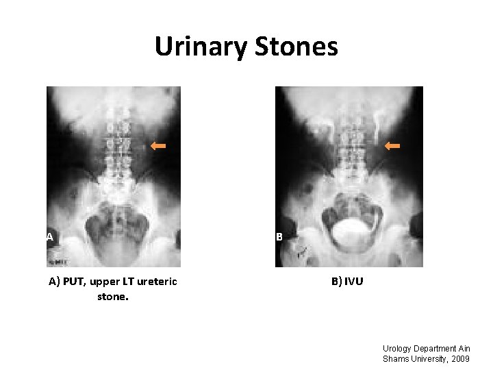 Urinary Stones A A) PUT, upper LT ureteric stone. B B) IVU Urology Department