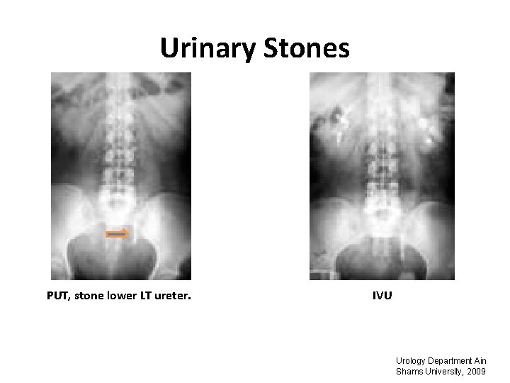 Urinary Stones PUT, stone lower LT ureter. IVU Urology Department Ain Shams University, 2009