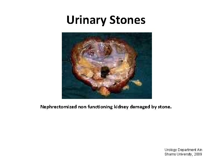 Urinary Stones Nephrectomized non functioning kidney damaged by stone. Urology Department Ain Shams University,