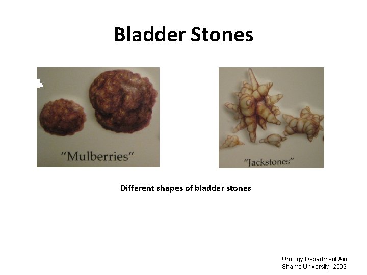 Bladder Stones Different shapes of bladder stones Urology Department Ain Shams University, 2009 