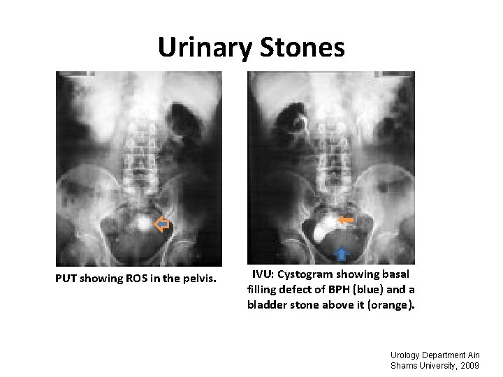 Urinary Stones PUT showing ROS in the pelvis. IVU: Cystogram showing basal filling defect