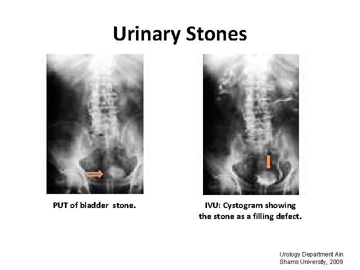 Urinary Stones PUT of bladder stone. IVU: Cystogram showing the stone as a filling