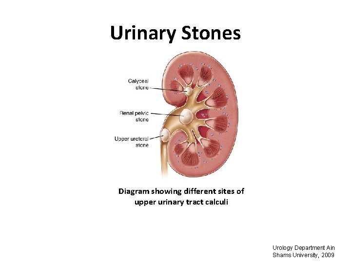 Urinary Stones Diagram showing different sites of upper urinary tract calculi Urology Department Ain
