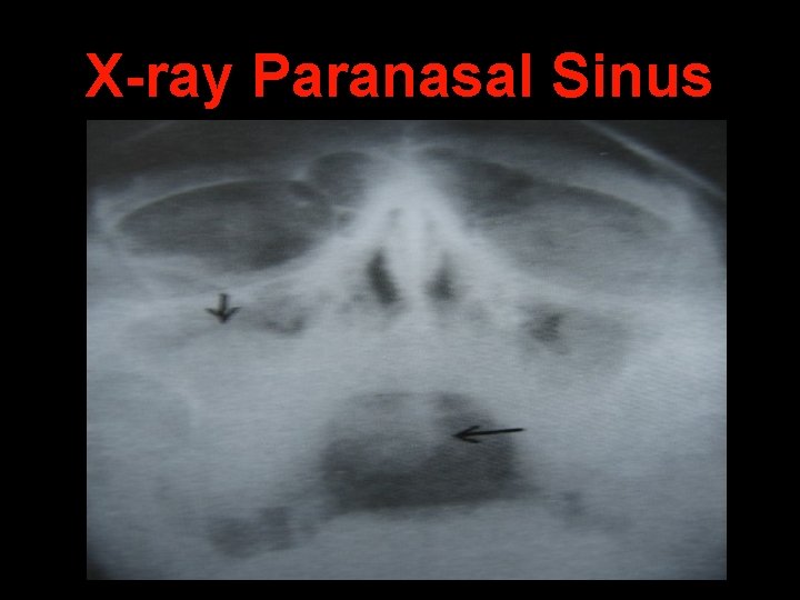 X-ray Paranasal Sinus 