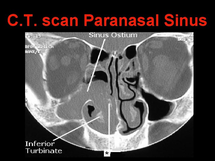 C. T. scan Paranasal Sinus 