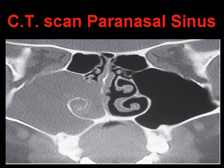 C. T. scan Paranasal Sinus 