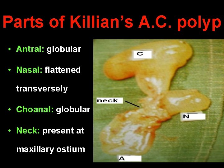 Parts of Killian’s A. C. polyp • Antral: globular • Nasal: flattened transversely •