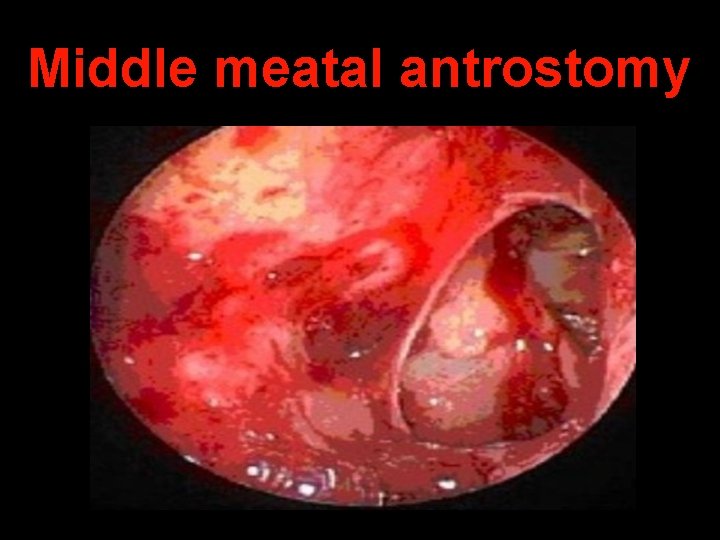 Middle meatal antrostomy 