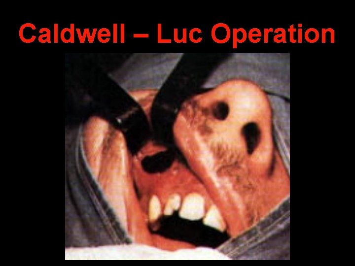 Caldwell – Luc Operation 