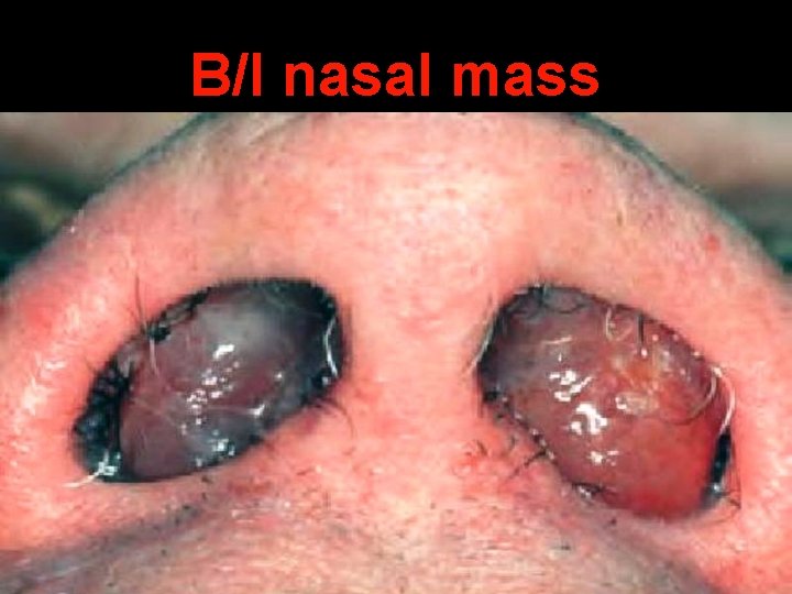 B/l nasal mass 