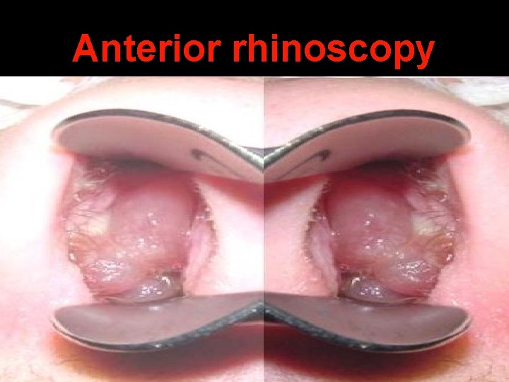 Anterior rhinoscopy 