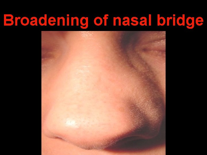 Broadening of nasal bridge 