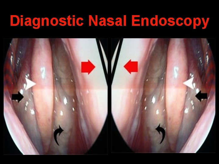 Diagnostic Nasal Endoscopy 