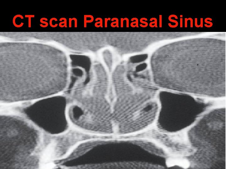 CT scan Paranasal Sinus 