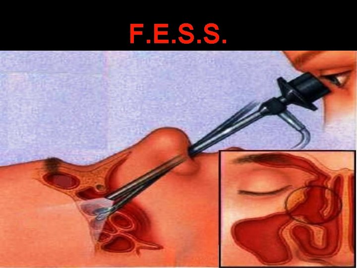 F. E. S. S. 