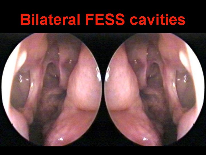 Bilateral FESS cavities 
