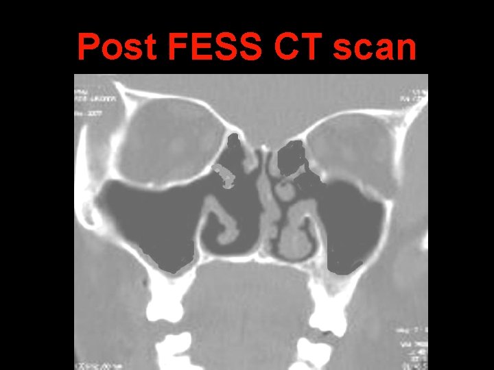 Post FESS CT scan 
