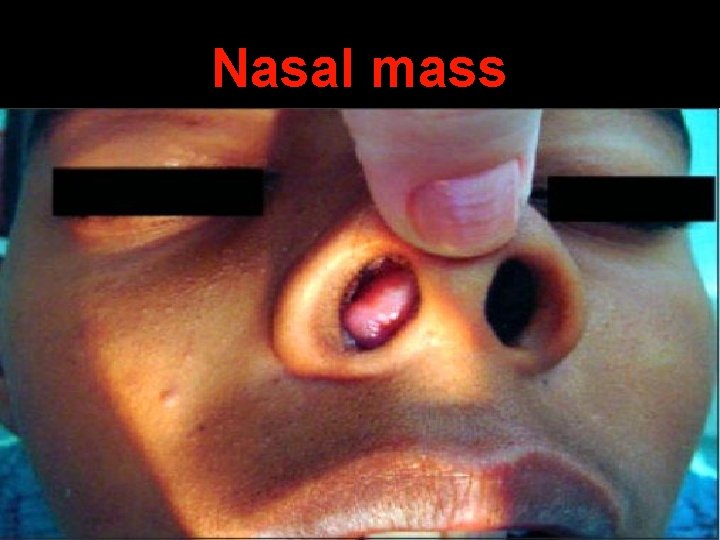 Nasal mass 