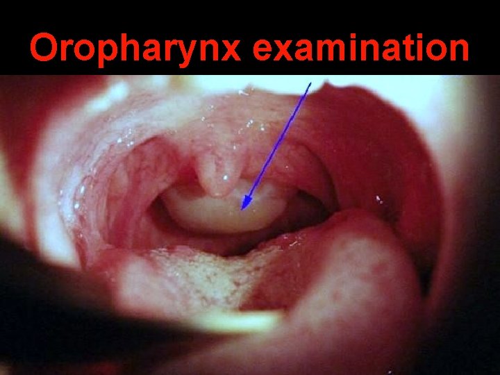 Oropharynx examination 