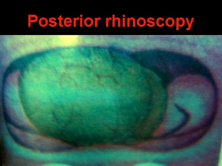 Posterior rhinoscopy 