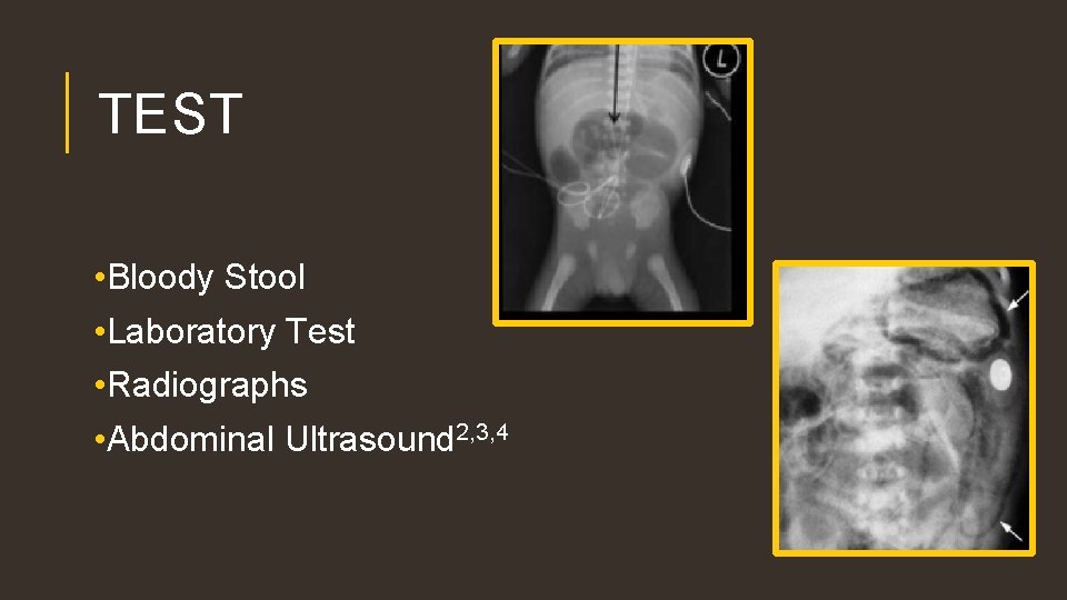 TEST • Bloody Stool • Laboratory Test • Radiographs • Abdominal Ultrasound 2, 3,