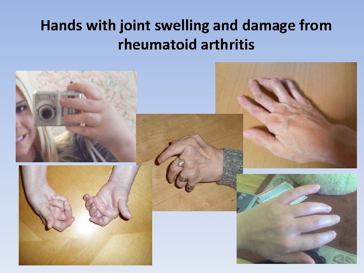 Hands with joint swelling and damage from rheumatoid arthritis 
