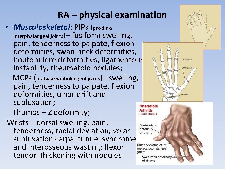 RA – physical examination • Musculoskeletal: PIPs (proximal interphalangeal joints)– fusiform swelling, pain, tenderness