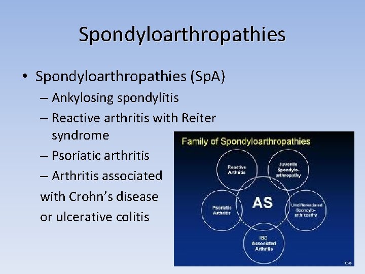 Spondyloarthropathies • Spondyloarthropathies (Sp. A) – Ankylosing spondylitis – Reactive arthritis with Reiter syndrome