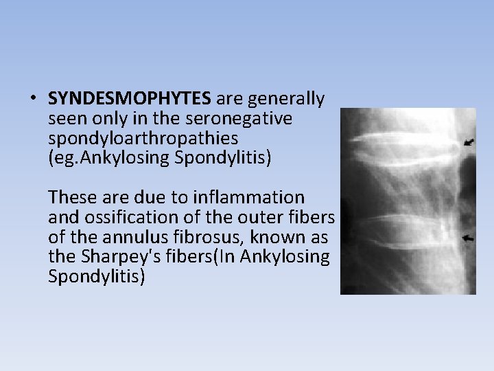 • SYNDESMOPHYTES are generally seen only in the seronegative spondyloarthropathies (eg. Ankylosing Spondylitis)